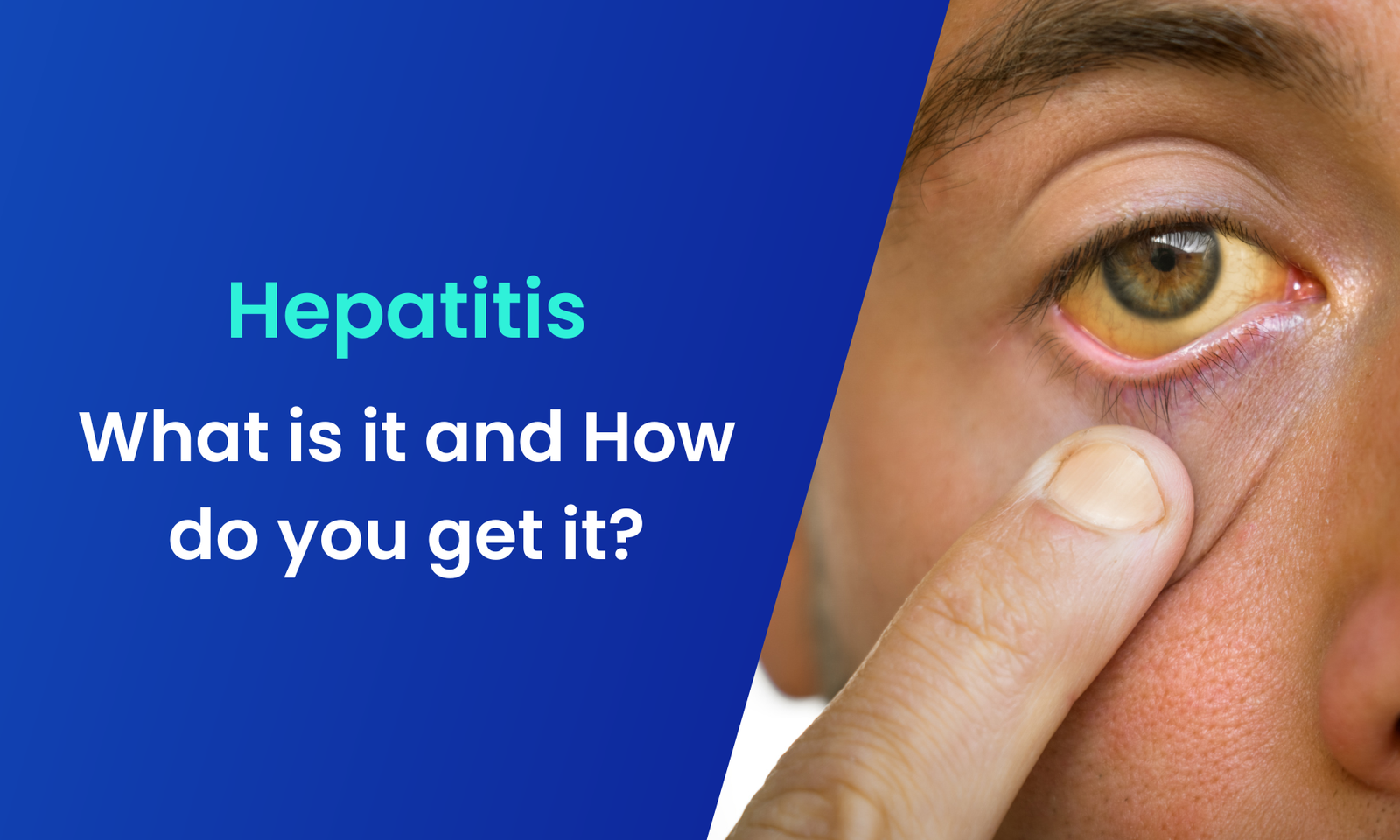 Hepatitis – What is it and How do you get it?
